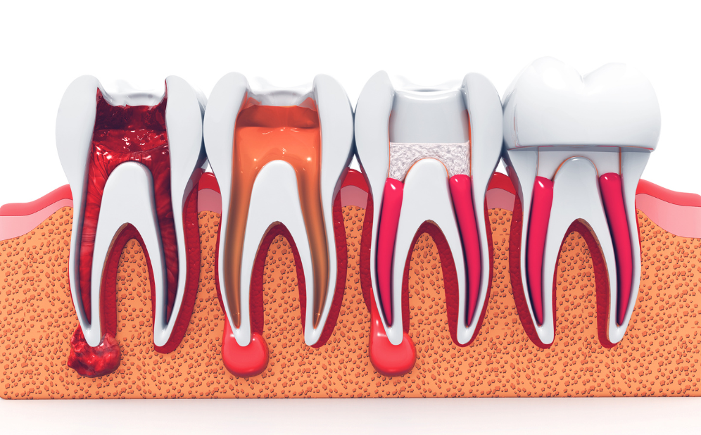 root canal treatment in Bogura - Namira Oro Dental Care